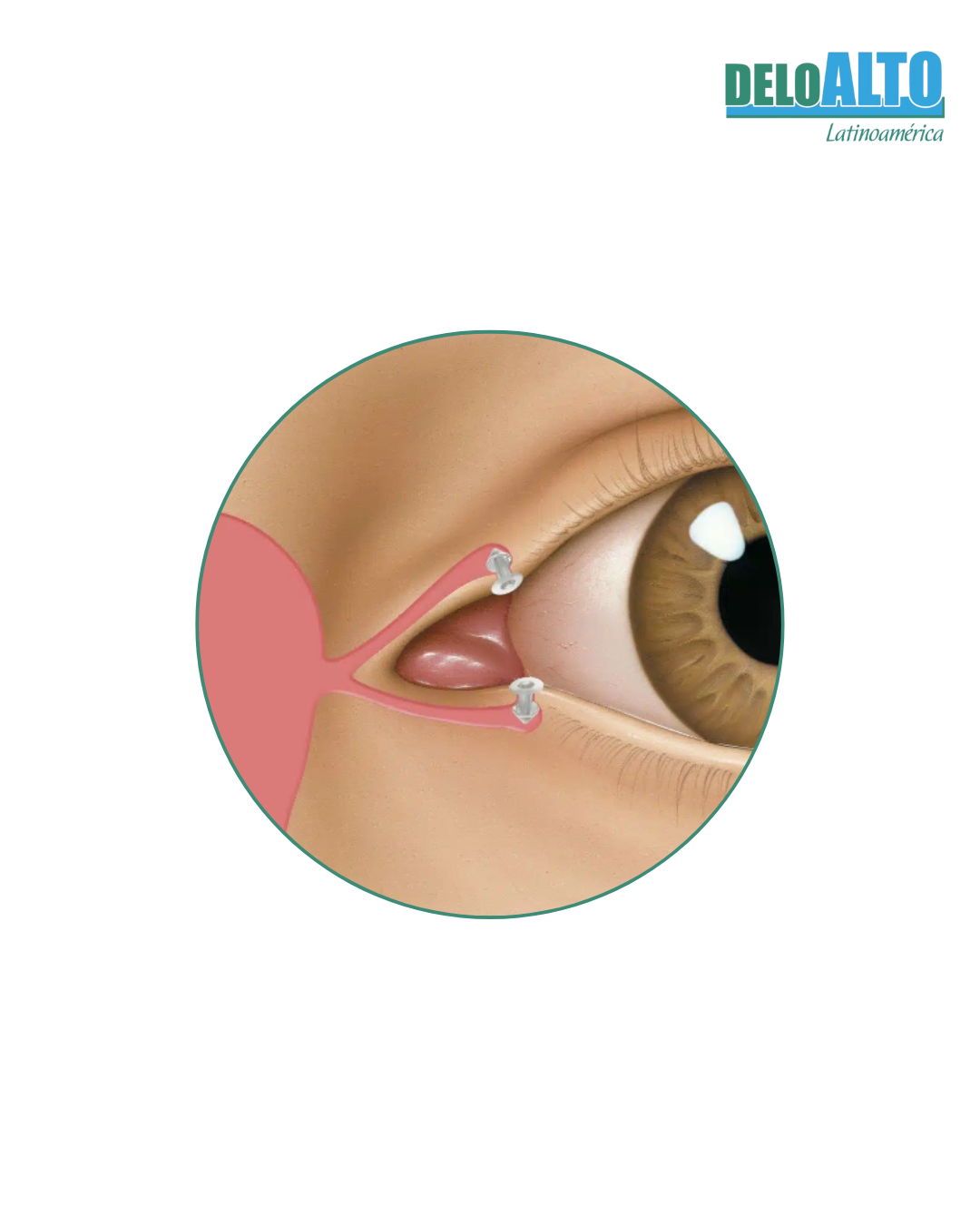 Tapones de Vía lagrimal ComfortTip
